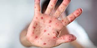 Measles Exposure Site Identified at Oregon City Medical Center, OHA Says