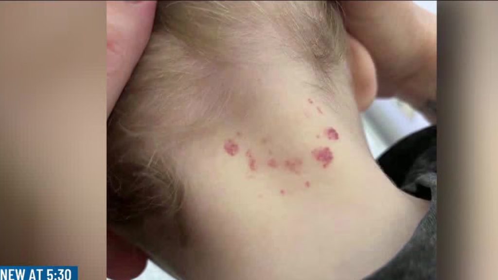 Toledo mother demands answers after mysterious mark appears on son after dental procedure