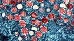 Two Mpox Cases Confirmed in Washoe County